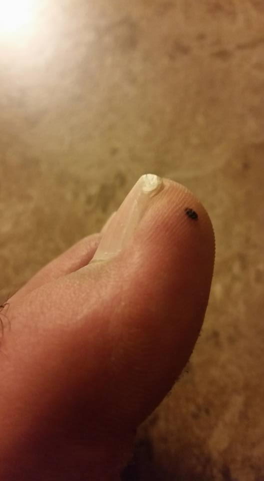 i-have-black-spot-on-my-toe-nail-nail-ftempo